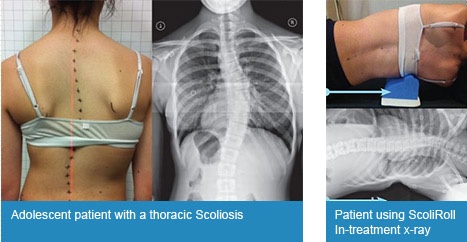 throacic scoliosis
