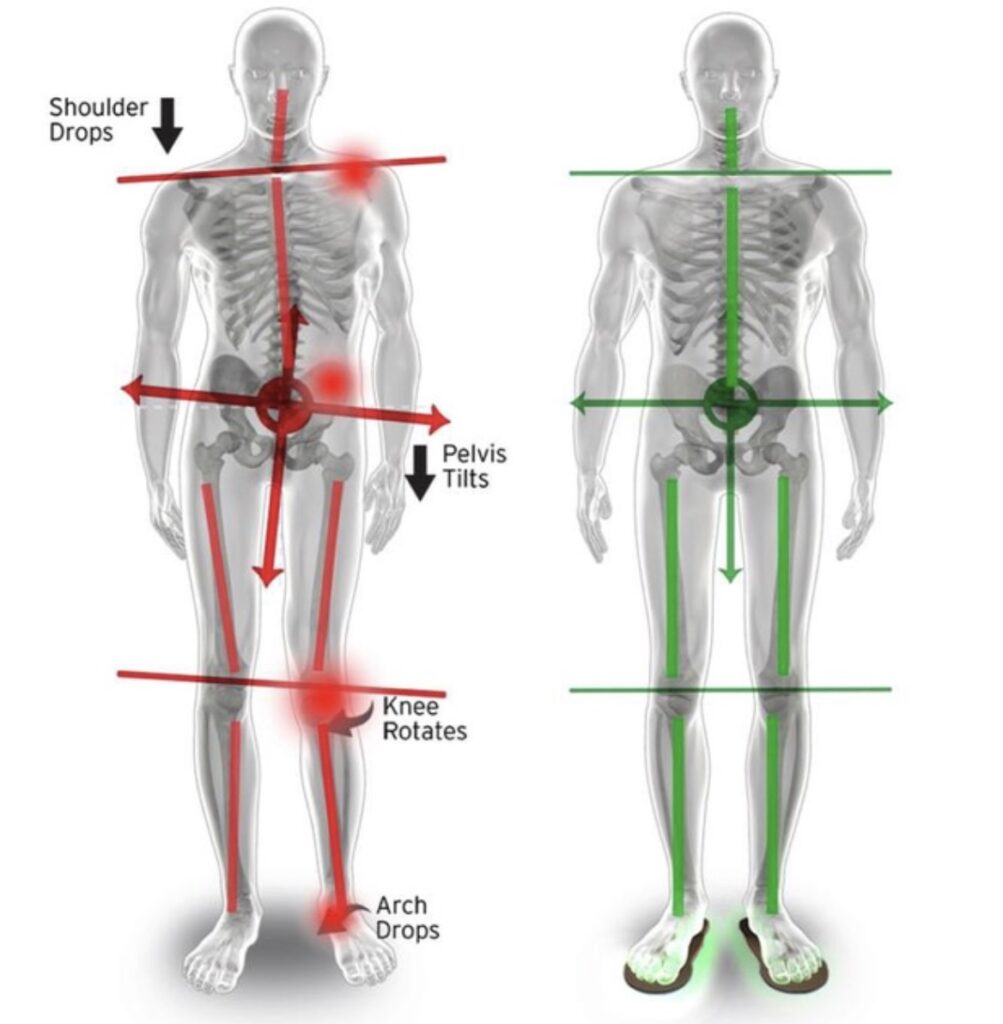 The Impact of Low Back on Hip, Knee, and Feet Imbalances