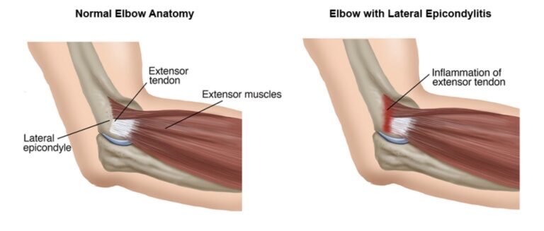 Tennis Elbow